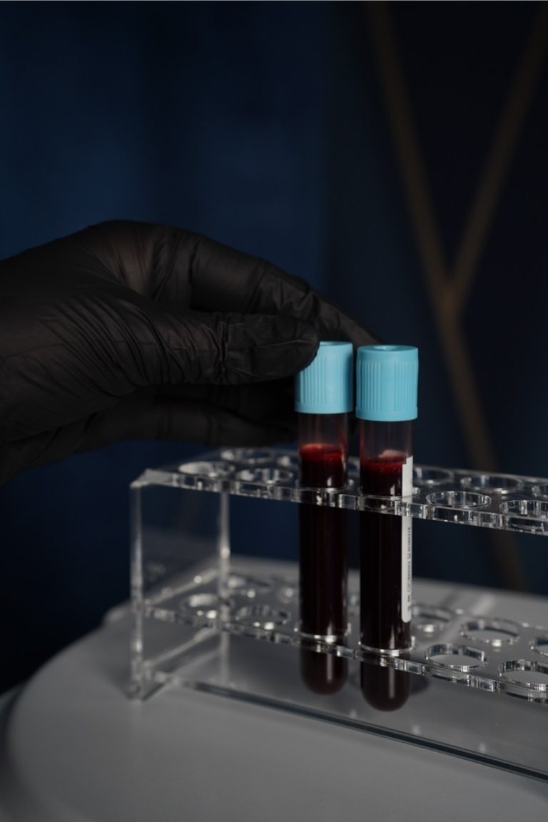 Osocze bogatopłytkowe – proces i etapy zabiegu