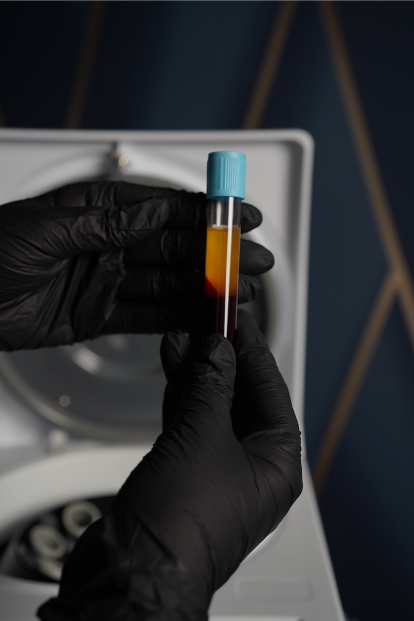 osocze bogatopłytkowe w rybniku